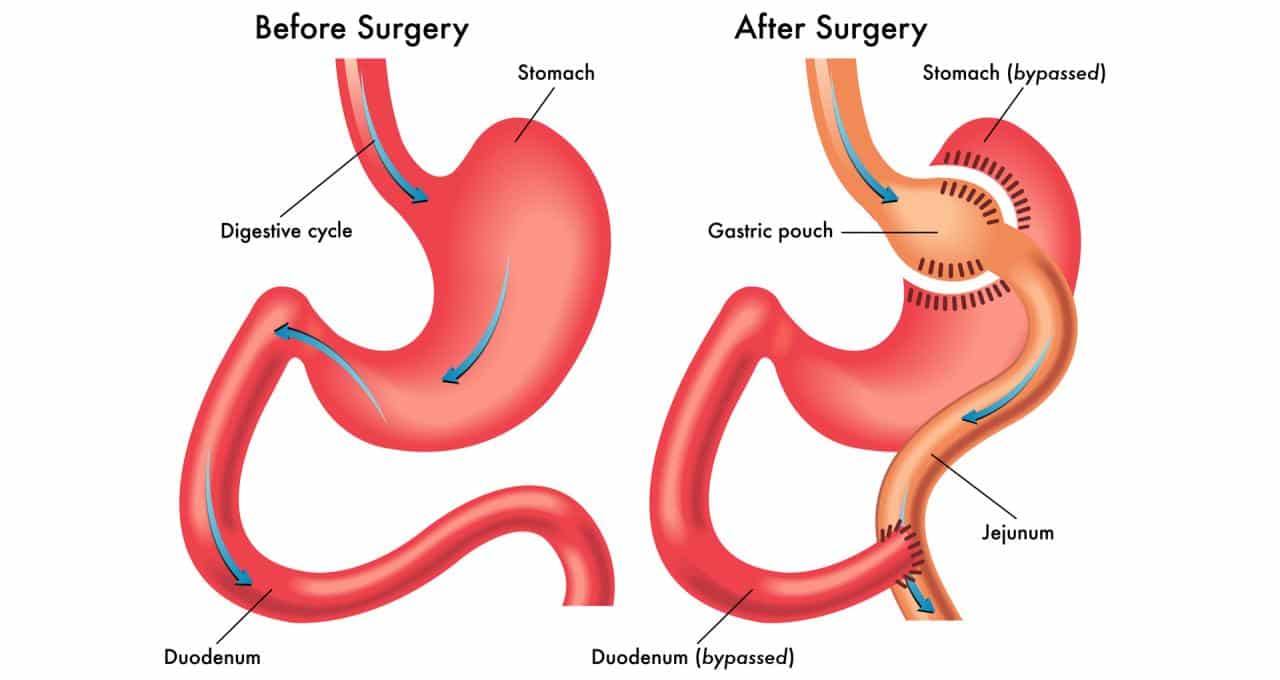 Gastric Sleeve Near Me