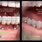 Affordable Dental Implants Near Me