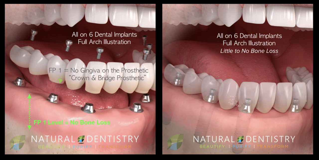 Affordable Dental Implants Near Me