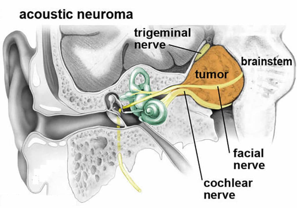 Acoustic Neuroma Youtube 2024